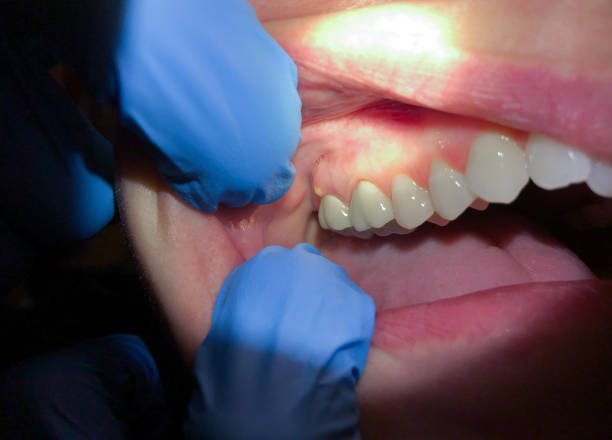 Best Emergency Dentist for Lost Fillings or Crowns in Royston, GA